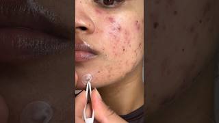 Pimple patch peel off. #pimplepatch #pimplepatches #acnepatch #acne #peeling #acnepositivity #acnes