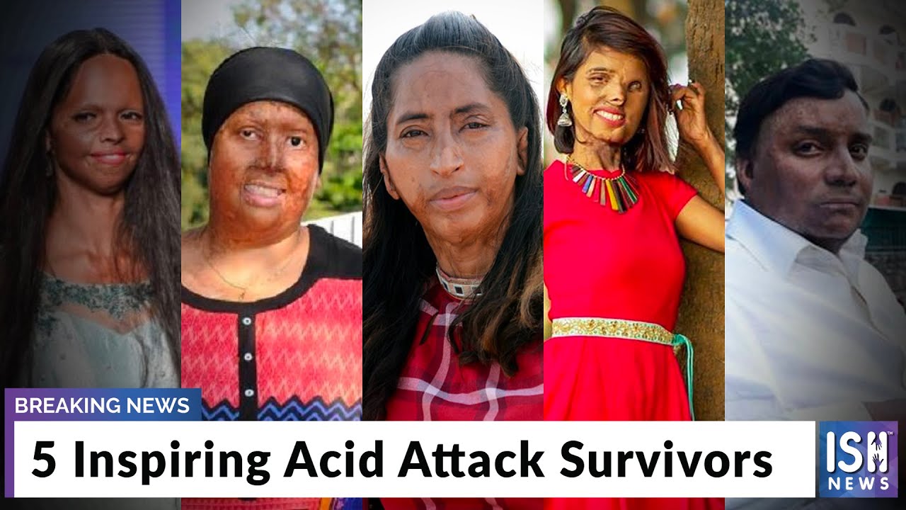 Acid Burn Victims Male acid-burn-victims-male