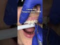 Cutting temporary smile 🪚🦷👀 #veneers #cutting #temporarysmile #asmr #asmrmouthsounds #veneerteeth
