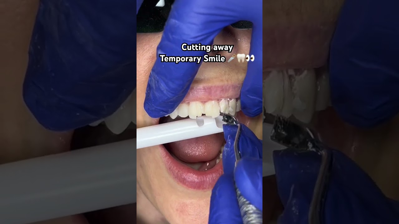Cutting temporary smile 🪚🦷👀 