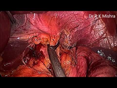 Laparoscopic Fundoplication