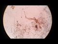 Undigested Food In Stool Microscopy
