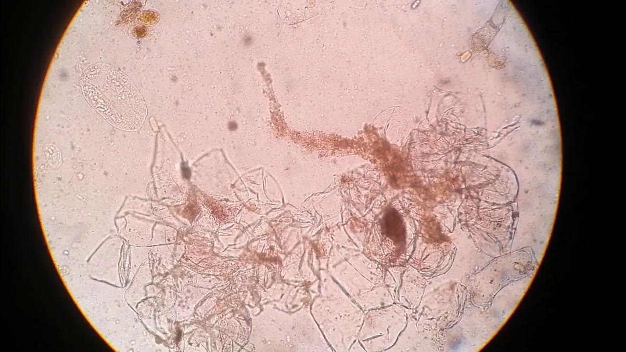 Undigested food particles of stool under microscope YouTube