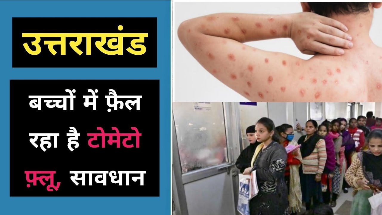 उत्तराखंड : बच्चों में फ़ैल रहा टोमेटो फ़्लू, क्या करें सावधानी | Uttrakhand tomato flu Bachcho bimari