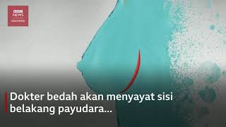 Bahaya di balik implan silikon pembesar payudara - BBC News Indonesia