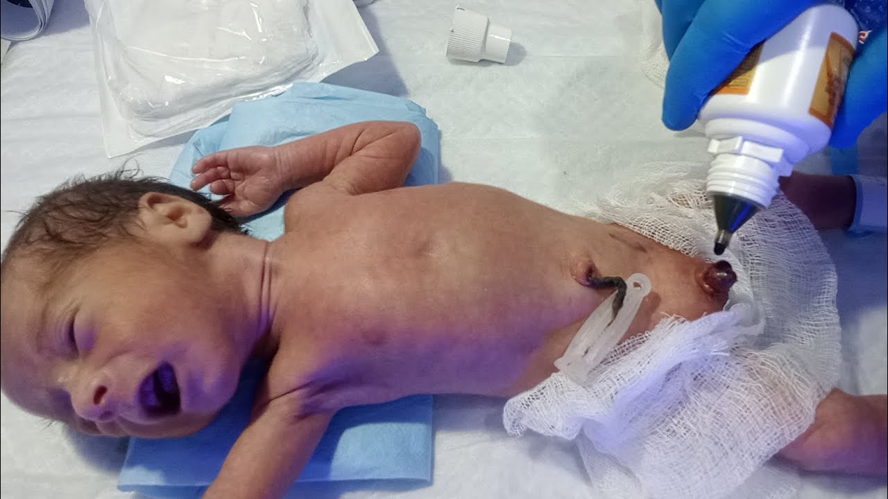 NICU Procedure | Circumcised Baby Dressing with Povidone Iodine