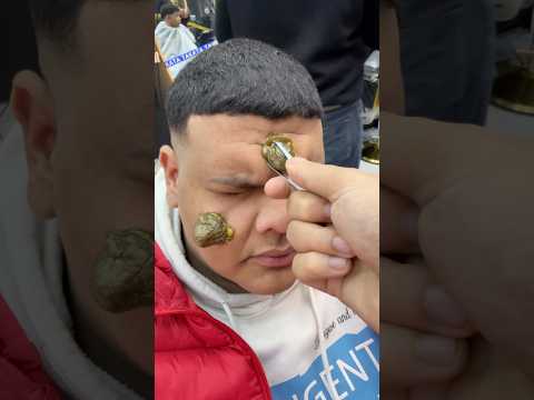 ازالة الحباية المتسلطنة من القورة       