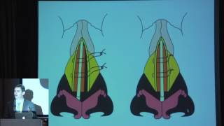 Download 15 A Landecker Refinements In Secondary Rhinoplasty Video MP3 15 A Landecker Refinements In Secondary Rhinoplasty