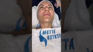 V-Line Memnuniyeti Metta Estetik