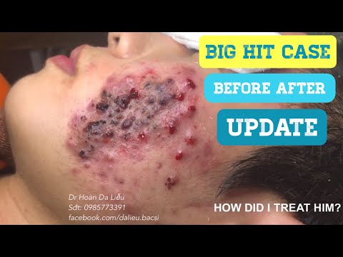 BIG HIT:Mụn nặng do điều trị sai|Dermatologist treating squeeze big pimples, whitehead after 4 weeks