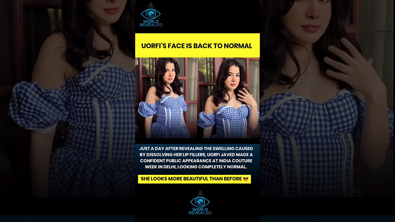 UORFI'S FACE IS BACK TO NORMAL