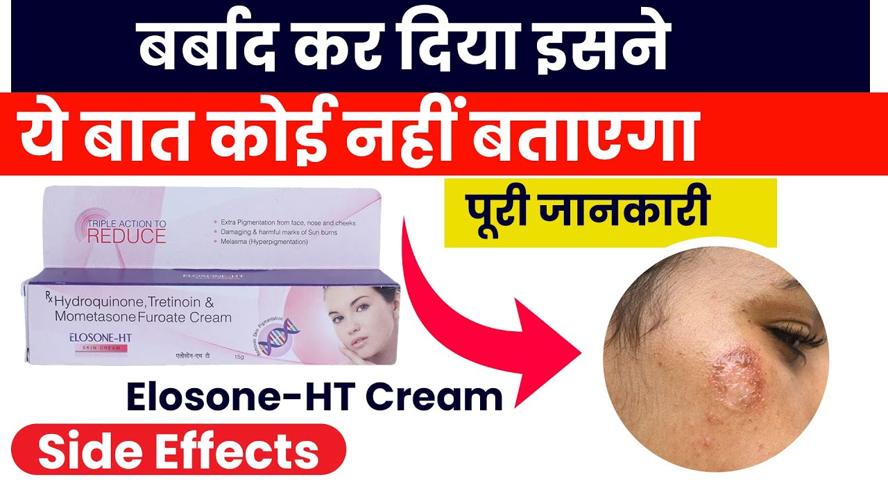 Elosone ht cream uses in hindi | How to use elosone ht cream in hindi | Elosone Cream कैसे लगायें