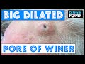 The Biggest Dilated Pore of Winer?!