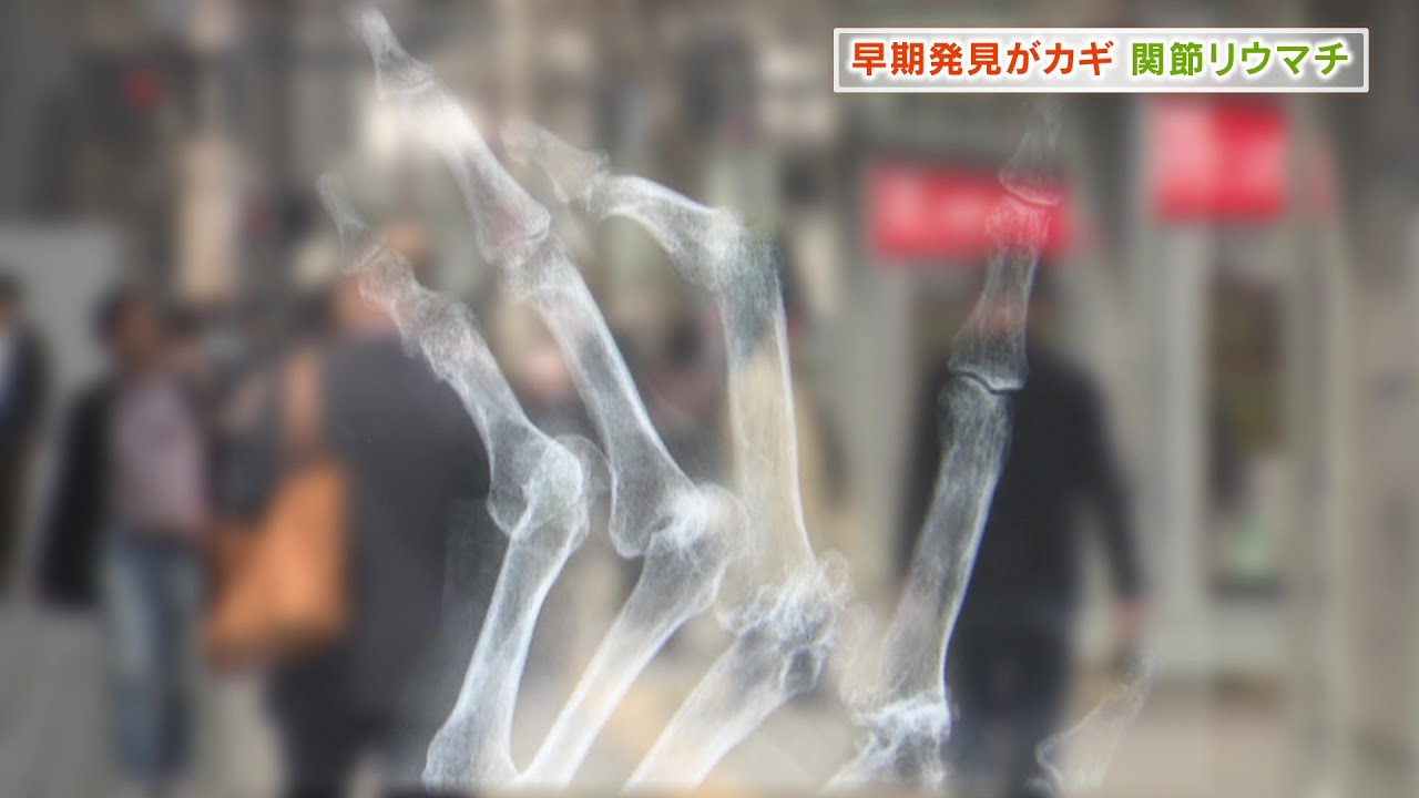 リウマチをあきらめない！～早期発見のポイント｜HBC北海道放送