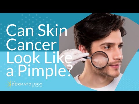 Can Skin Cancer Look Like a Pimple?