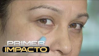 Acido con hialuronico ojeras de tratamiento