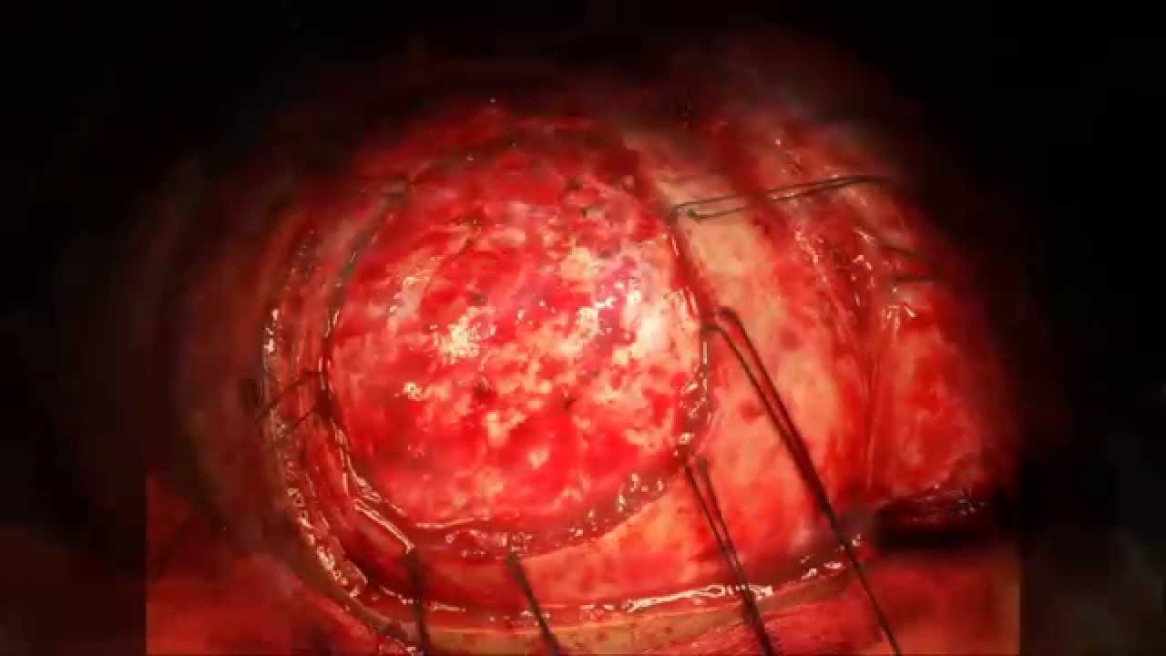 Fronto-Parietal Epidural Hematoma