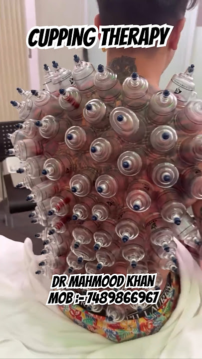 Cupping Therapy #cupping #cuppingtherapy #hijama #hijamatherapy #hijamaguy