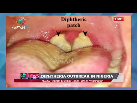 DIPTHERIA OUTBREAK IN NIGERIA: NCDC Reports Multiple Cases, Urges Vaccination