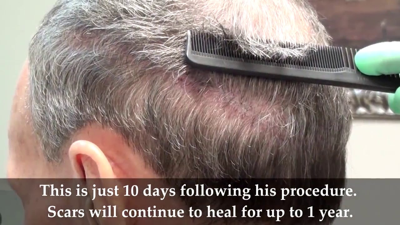 Best Hair Transplant & Restoration Techniques In Asheville, North