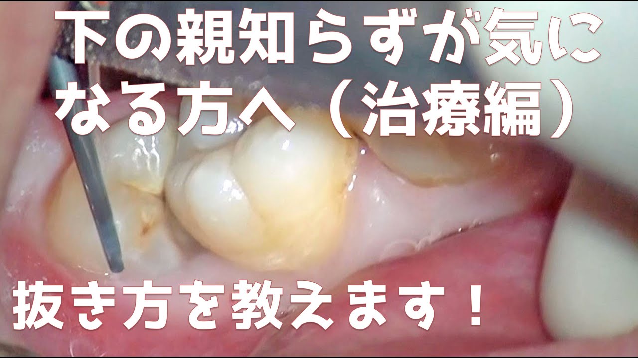 下の親知らずが気になる方へ治療編 Youtube