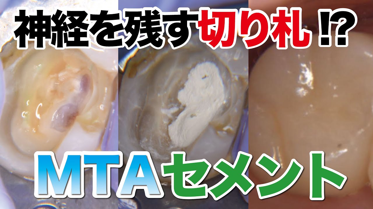 虫歯が深くても神経を残せる？！　MTAセメント治療とは？