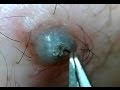 ほくろの毛を引っこ抜く！part11 Hair of a mole!