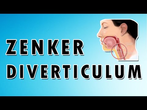 Video: 3 manieren om slokdarmdivertikel te diagnosticeren