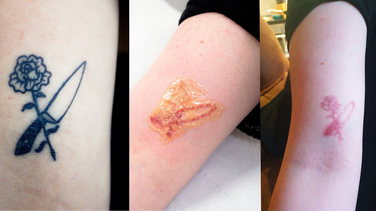 Laser Tattoo Removal  How Painful is it and Whats the procedure