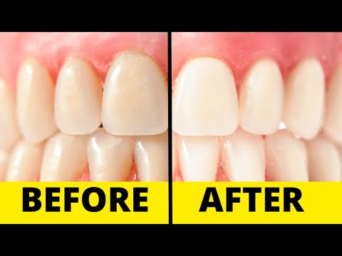Vídeo: 3 maneres de blanquejar-se les dents sense gastar molts diners