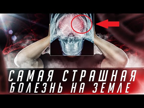 Синдром ФАТАЛЬНОЙ Семейной Бессонницы