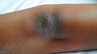 Home remedies for dark elbows and knees | How to treat dark elbows