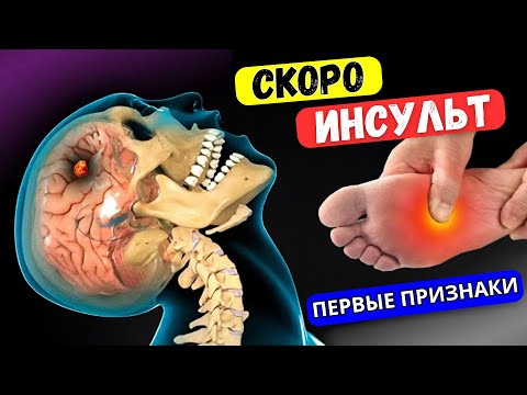 5 Признаков скорого ИНСУЛЬТА! Тело предупреждает вас... НЕ Пропусти - ВЫЖИВЕШЬ