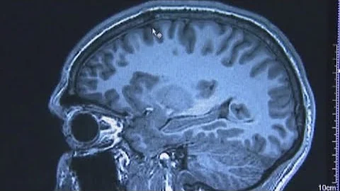 How to tell the difference between Alzheimer's Disease and Dementia