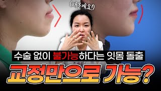 잇몸돌출을 수술 없이 교정으로 하면 생기는 일