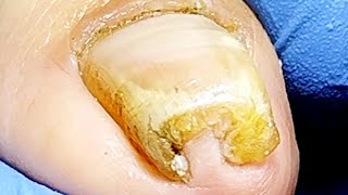 Download Lagu Noticeably Curled Toenails, Removal Of Ingrown Toenails【Pedicure King】 MP3