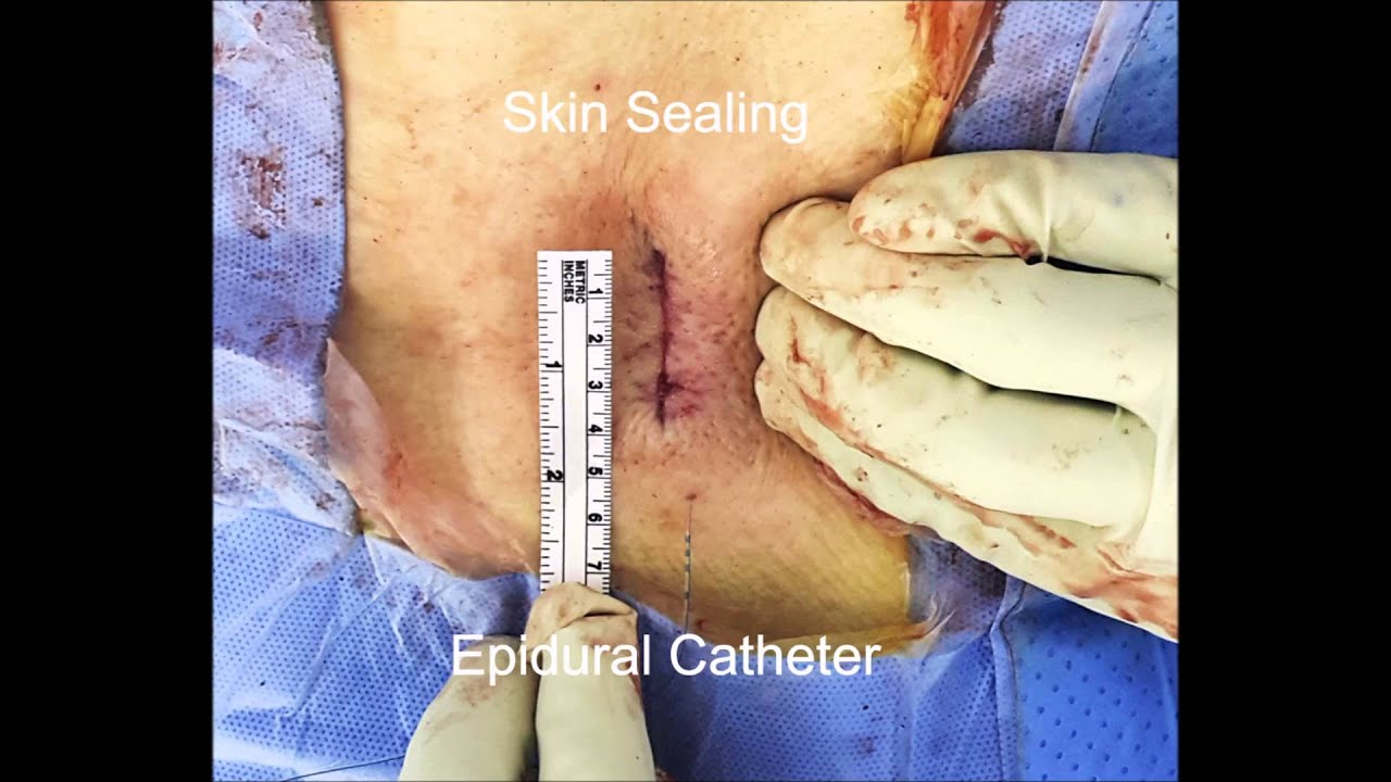 1 Day Lumbar Interbody Fusion Surgery Transforaminal