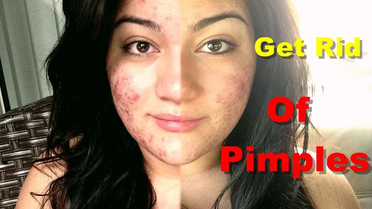 How to remove pimples Overnight Home Remedies Of How to Remove Pimples