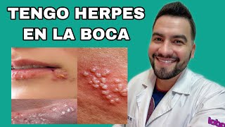 Tengo Herpes En La Boca Herpes Simple Dr David Campos