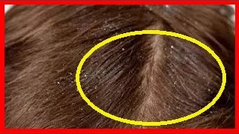 ¿Qué mata las liendres del pelo?