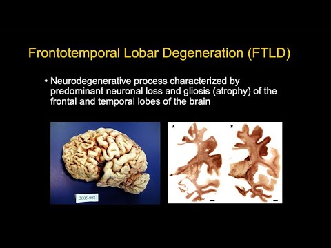 Looking Beyond Alzheimer’s Disease: An Overview of Other Major Forms of Neurodegenerative Disease