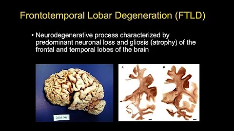 Looking Beyond Alzheimer’s Disease: An Overview of Other Major Forms of Neurodegenerative Disease - DayDayNews