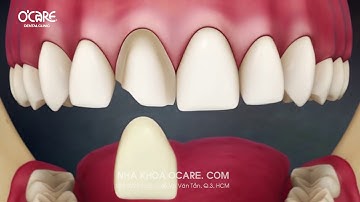 Dán răng sứ Veneer siêu mỏng, không lẩy tủy