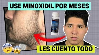 NUNCA USES MINOXIDIL POR ESTA RAZÓN! - Mi experiencia con 7 meses usando minoxidil