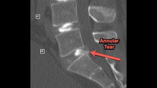 Toxic Annular Tears - Part 1 of 3 (Symptoms and MRI)