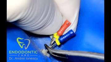 Using Braided Hedstroms to remove a Thermafil carrier - Dr. Andrei Ionescu