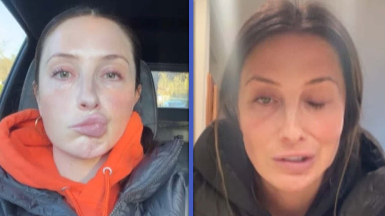 Bristol Palin Reveals Facial Paralysis Diagnosis