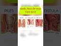 बवासीर, फिशर और भगन्दर में क्या अन्तर है । Piles, Anal Fissure & Fistula #viral #shorts #shortsvideo
