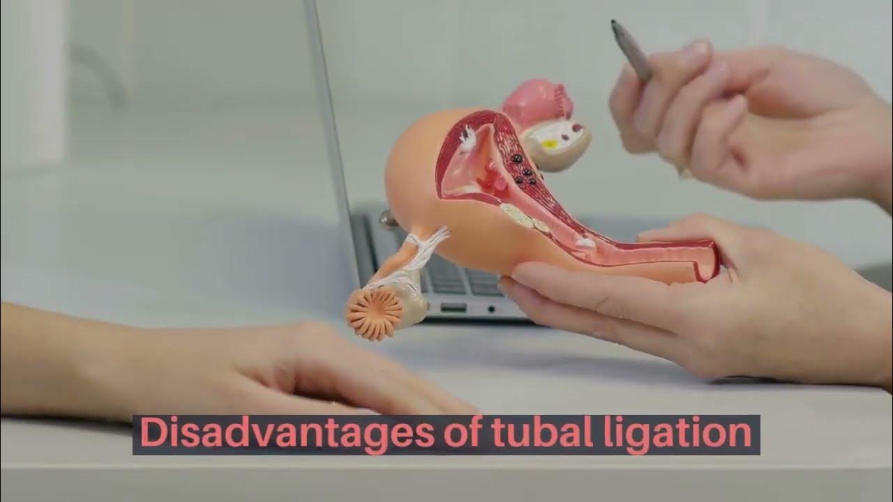 Tubal Ligation All You Need To Know YouTube