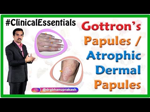 Gottron’s papules / Atrophic dermal papules : Clinical essentials